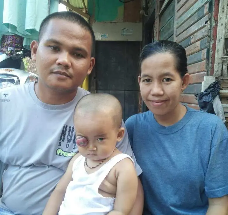 Balita Aysha Maydita Butuh Bantuan Dermawan Untuk Operasi Matanya